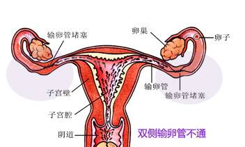 ②输卵管通而不畅:精子和卵子经过重重关卡相见并合体,但受精卵在
