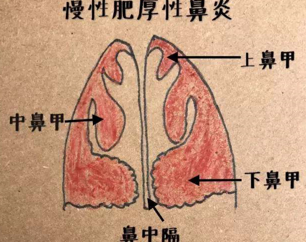 耳鼻喉王虎专家介绍:大人小孩都会遇到的疾病—鼻炎