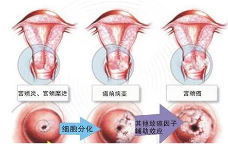 急性宫颈炎和不孕有什么关系