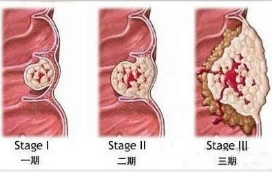 女性痔疮