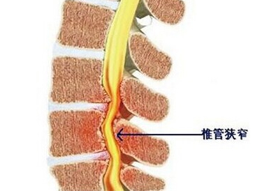 腰椎管狭窄有哪些明显症状