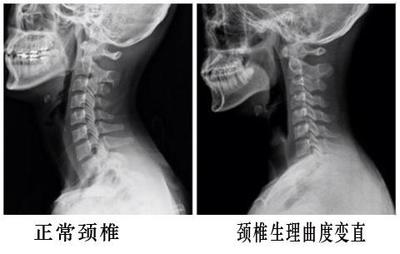 颈椎变直怎么办?_家庭医生在线官网网站