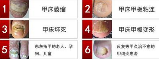 指甲疼痛有可能是甲沟炎
