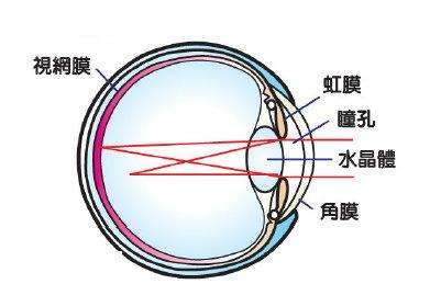 平时视力也正常,但是体检验眼时却发现有100度的散光,为此