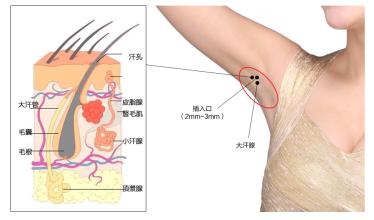 中国狐臭人口_...方 天热了,有狐臭的人赶紧灸,几次就好了