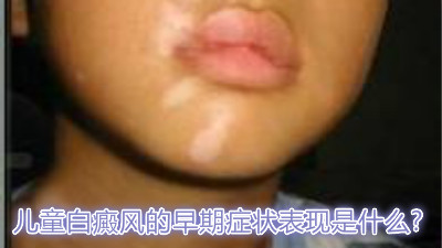 嘴唇上有白癜风该怎么办