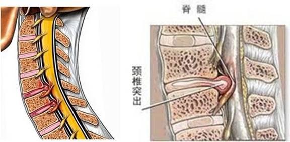 擅长颈椎间盘突出_颈椎间盘突出临床表现_3 4 5 6 7颈椎间盘突出