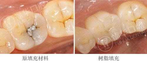蛀牙不補,牙齒不保:納米樹脂補牙,更耐磨更逼真