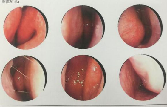 宁波同仁王虎成功治疗慢性咽炎案例 鼻部:双侧鼻腔粘膜慢性充血
