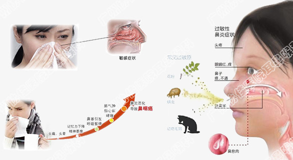 支氣管哮喘並過敏性鼻炎的護理干預