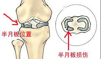 半月板损伤怎么回事?骨科专家详细讲解
