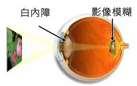 白內障早期症狀治療方法